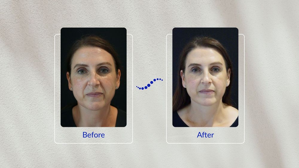 Julie's Pigmentation Journey with REVIV