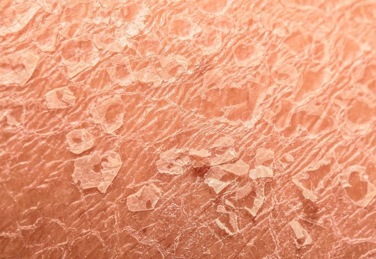 glutathione psoriatic arthritis and Autoimmune Disease A Promising Approach to Psoriasis