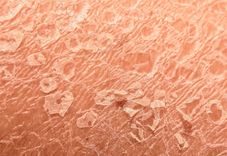 Glutathione: A Skin Savior for Pigmentation & Psoriasis - REVIV
